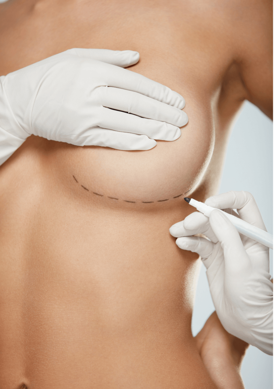 Breast consultation planning visual